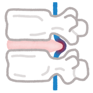 神経圧迫が原因の腰痛